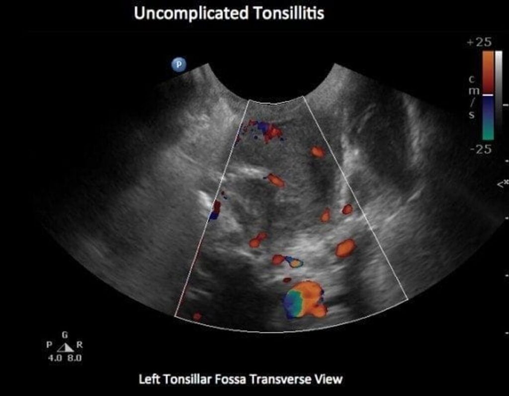 Can Tonsils Grow Back After Being Removed? - Tymoff